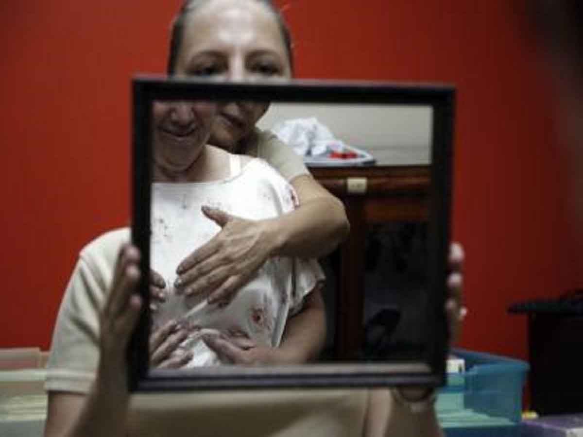 Chemotherapy in childhood may raise breast cancer risk later