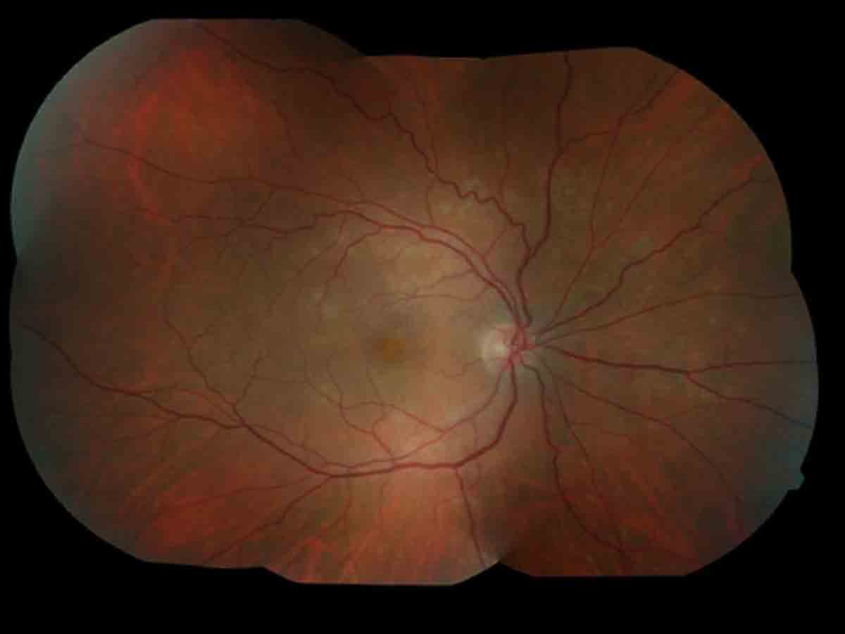 1st case of white dot syndrome post Covid vax & subsequent infection: Study