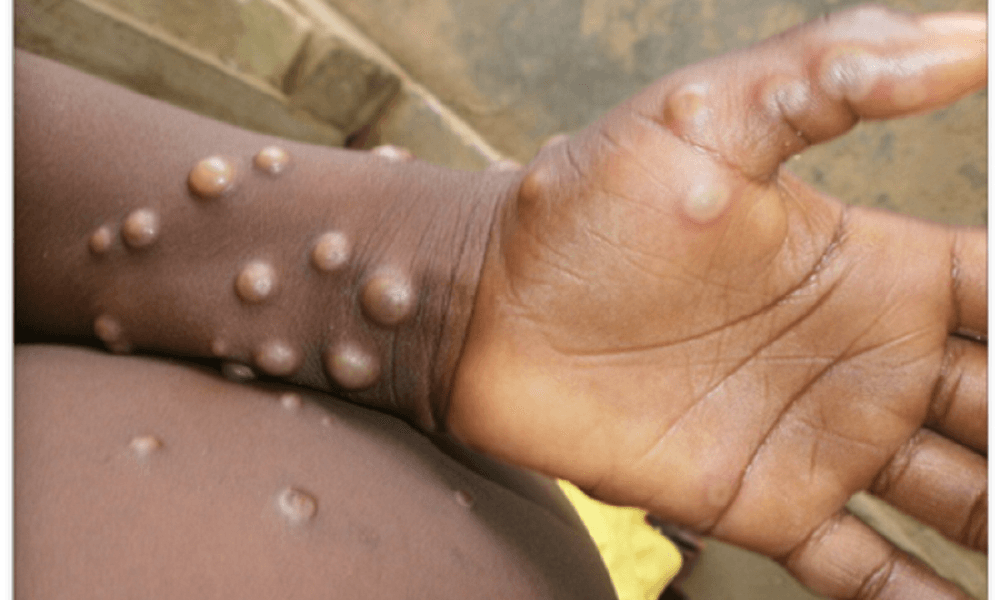 11% mpox patients also had eye diseases: Study