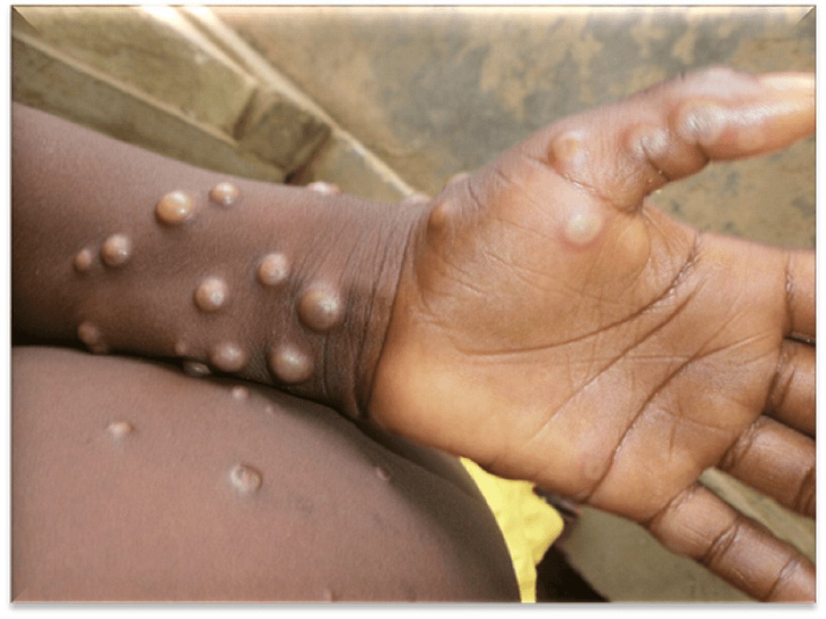 11% mpox patients also had eye diseases: Study