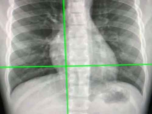 New AI tool can detect Covid infection from chest X-rays 98% accuracy
