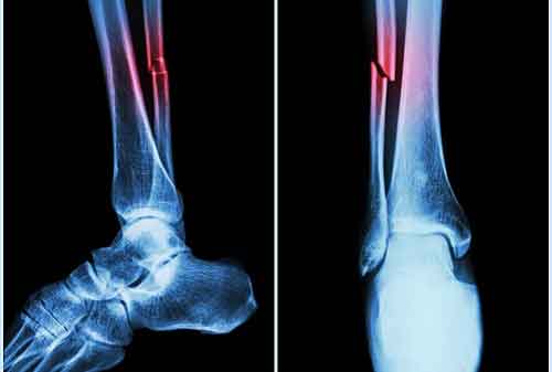 Can AI help patients with bone fractures?
