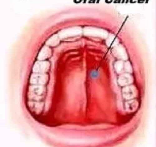 Why India is seeing a rise in oral cancer cases
