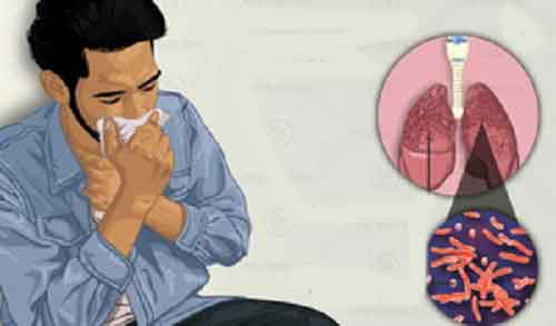 Indian study shows whole-genome sequencing key to detect drug-resistant TB early