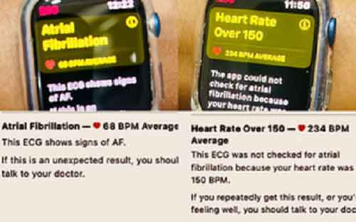 Apple Watch saves Delhi woman’s life by alerting abnormal heart rhythm