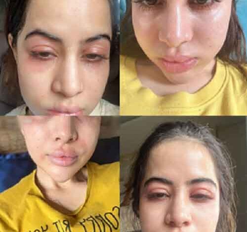 Uorfi Javed clarifies she has ‘major allergies’ and hasn’t gone ‘overboard with fillers’