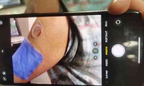Researchers develop wearable device that measures levels of disease markers via ‘sweat’