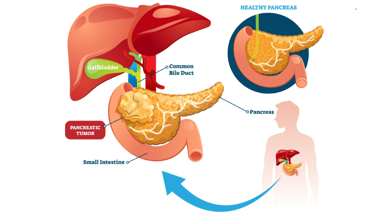 Understanding pancreatic cancer: Symptoms, causes, and prevention