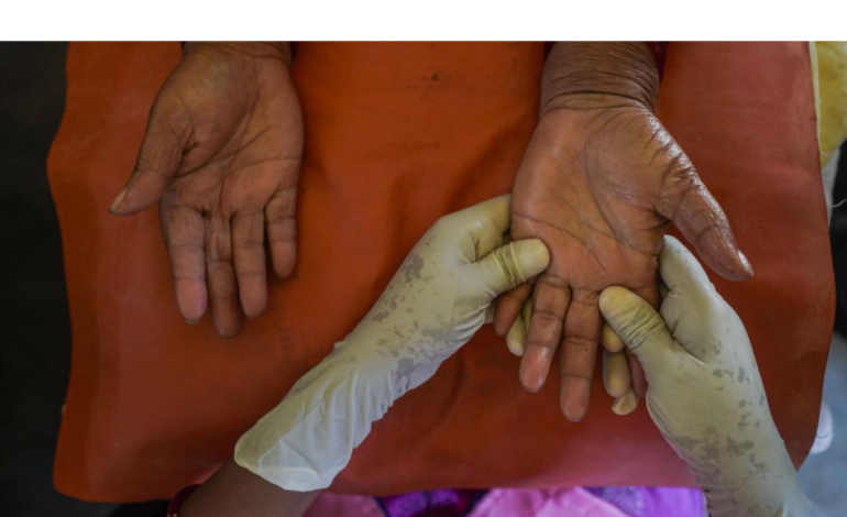 India accounts for 53% of global leprosy cases, need for legal reforms: experts