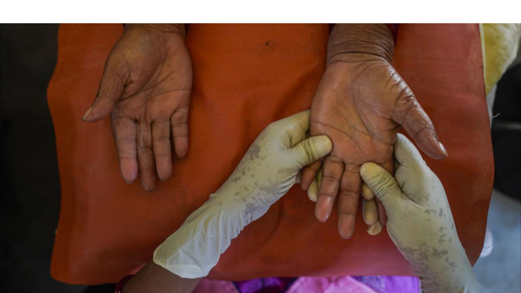 India accounts for 53% of global leprosy cases, need for legal reforms: experts