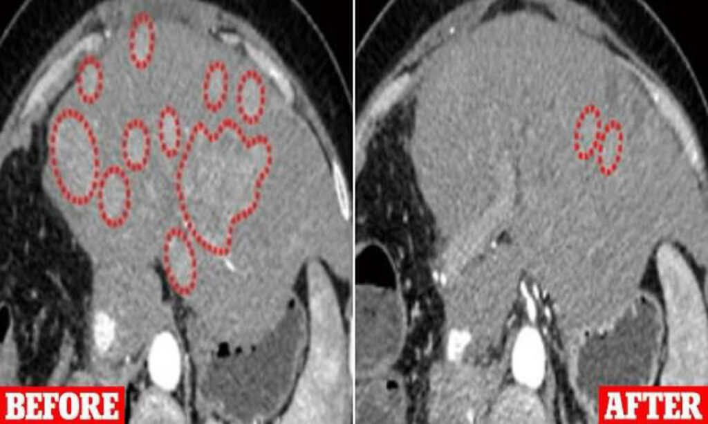 Potential cancer breakthrough: Novel virus therapy shows promise in shrinking tumors