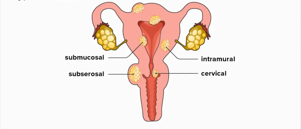 Understanding uterine fibroids: Causes, symptoms, and treatment