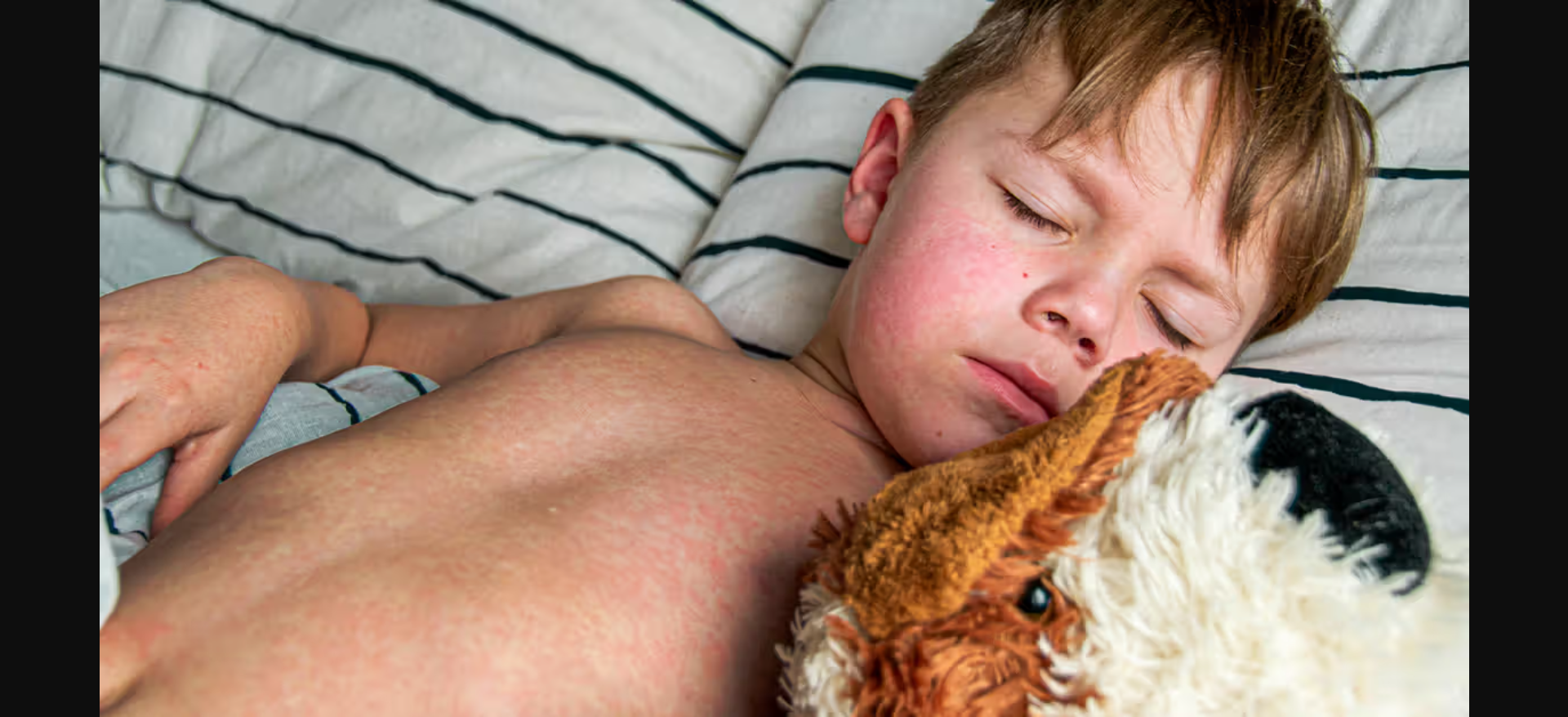 Measles resurgence in the U.S.: Largest outbreak in six years raises public health concerns