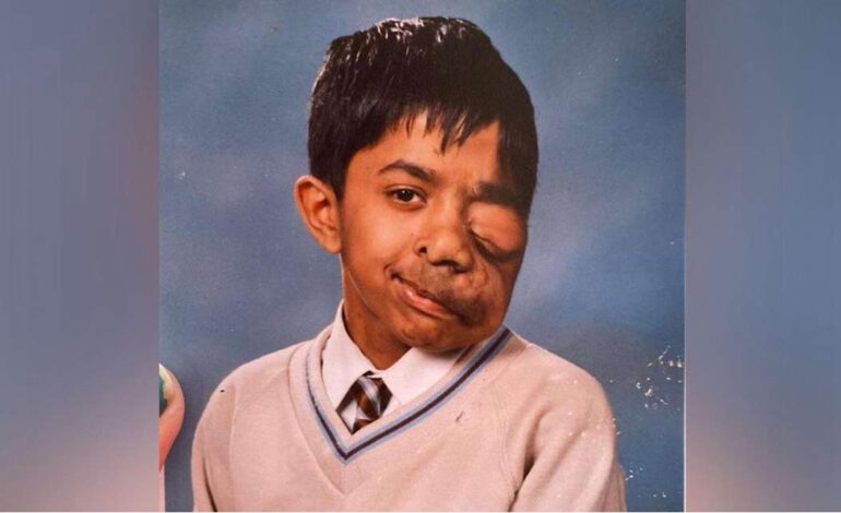 “My face shouldn’t define me” Amit Ghose’s journey from pain to purpose