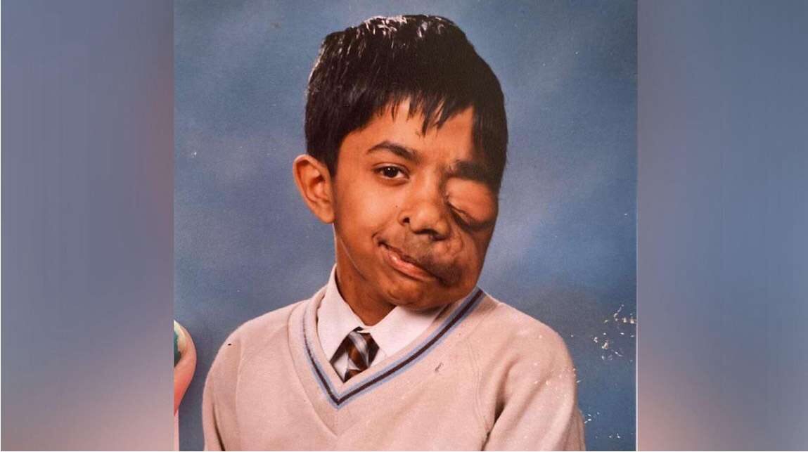 “My face shouldn’t define me” Amit Ghose’s journey from pain to purpose