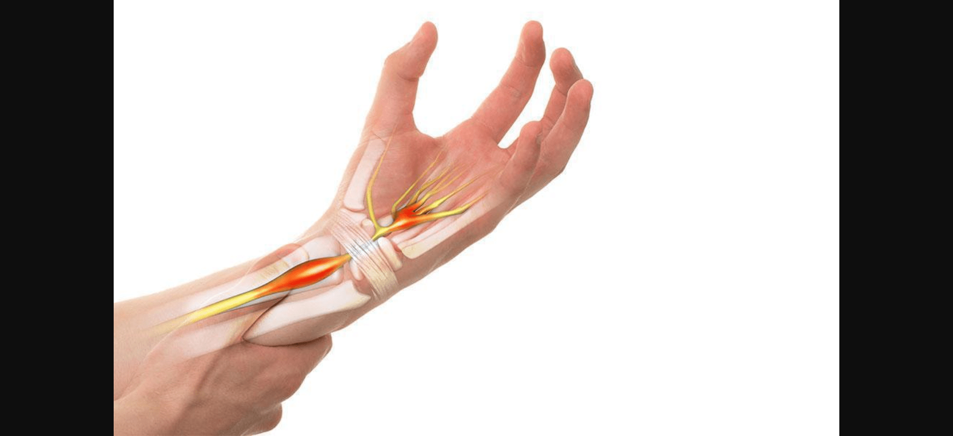Understanding carpal tunnel syndrome: early action is key