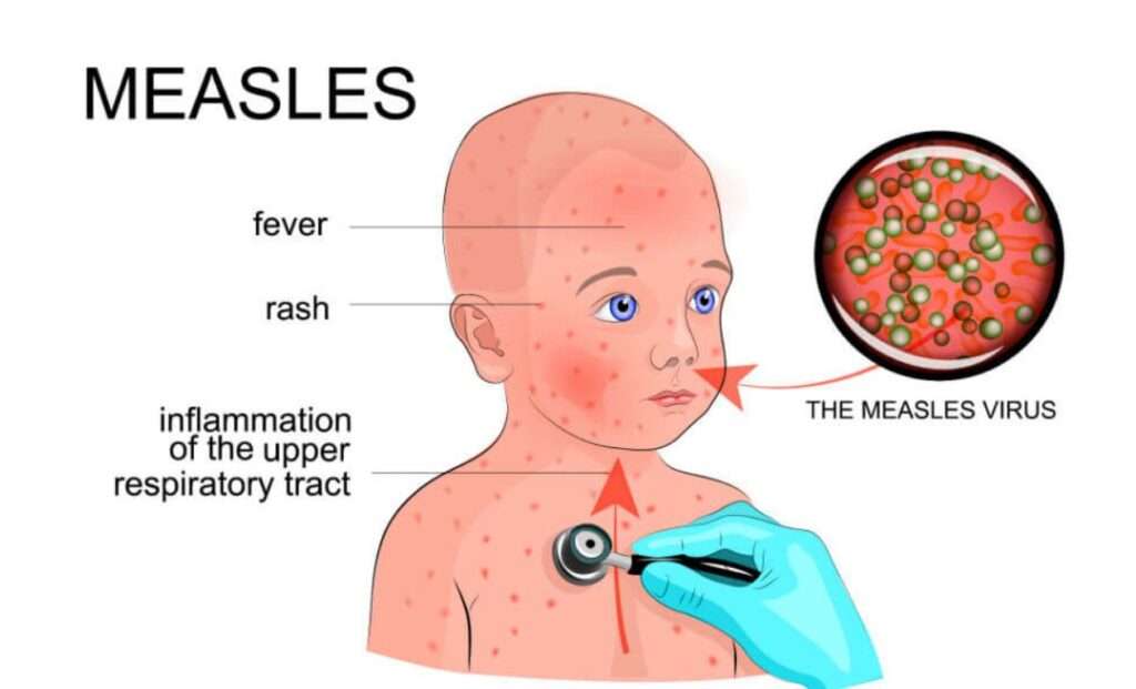 US issues measles travel alert amid rising airborne cases