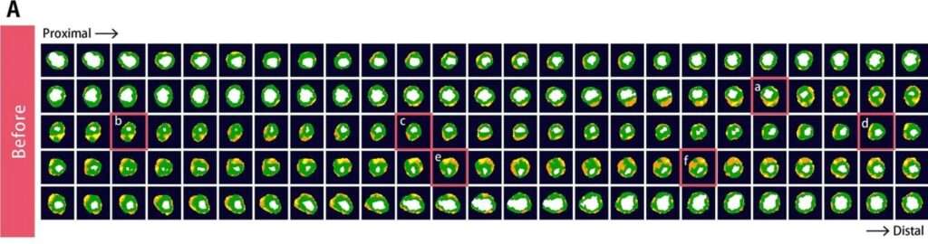 Japanese study shows supplement reversing rare heart disease