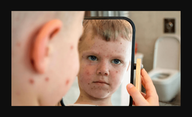 Measles cases surge across the U.S.: How to keep your child and family safe