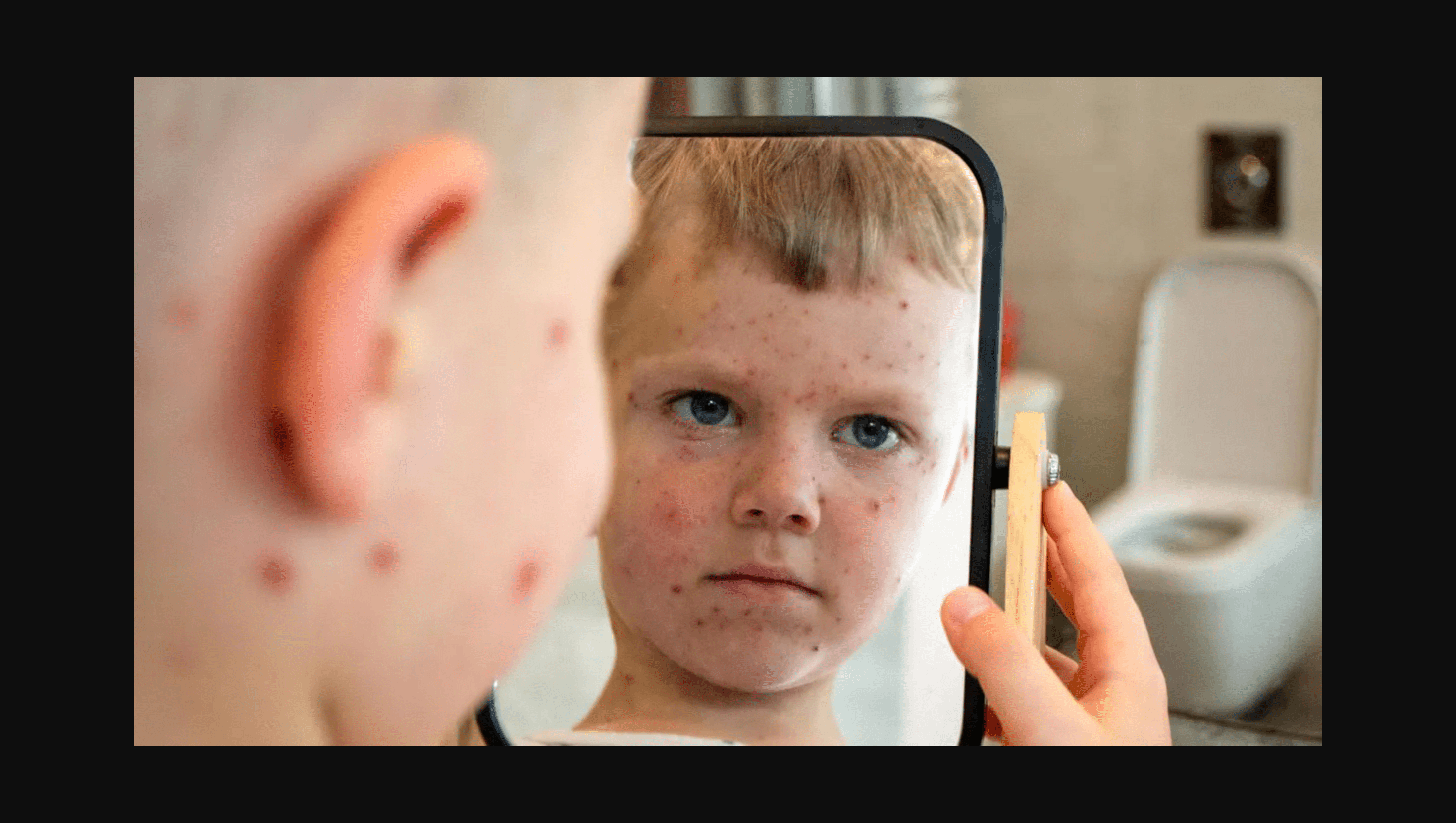 Measles cases surge across the U.S.: How to keep your child and family safe