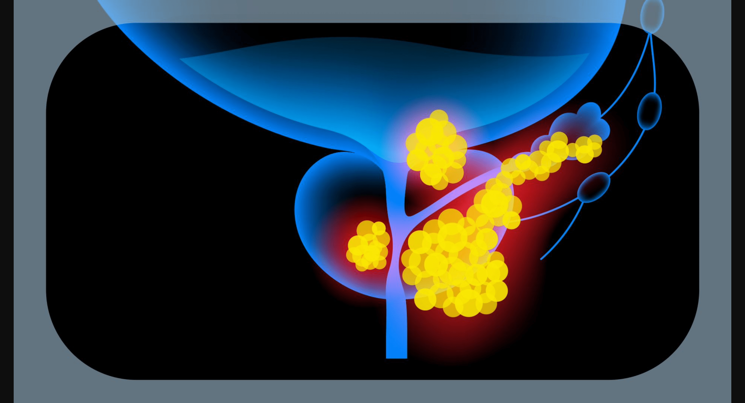 Drug combination boosts prostate cancer survival by ~40%: what to know