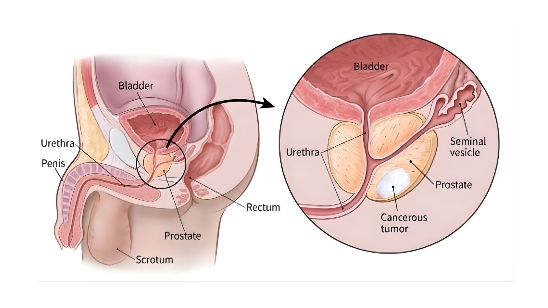 Early trial shows promise for new prostate cancer immunotherapy