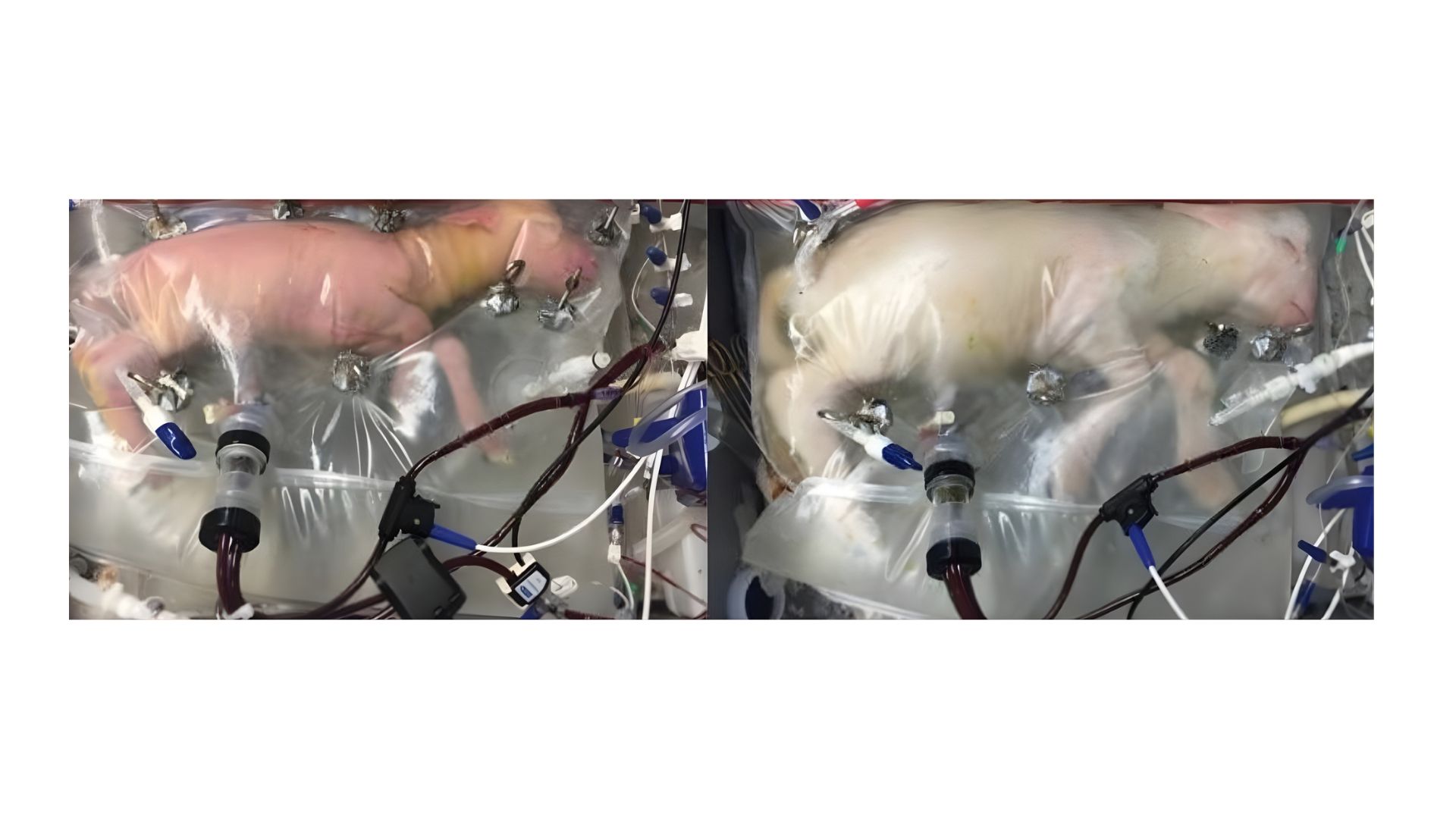Artificial womb technology: A new frontier in saving extremely premature infants