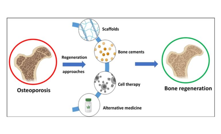 New directions in osteoporosis treatment Focus on bone regeneration science