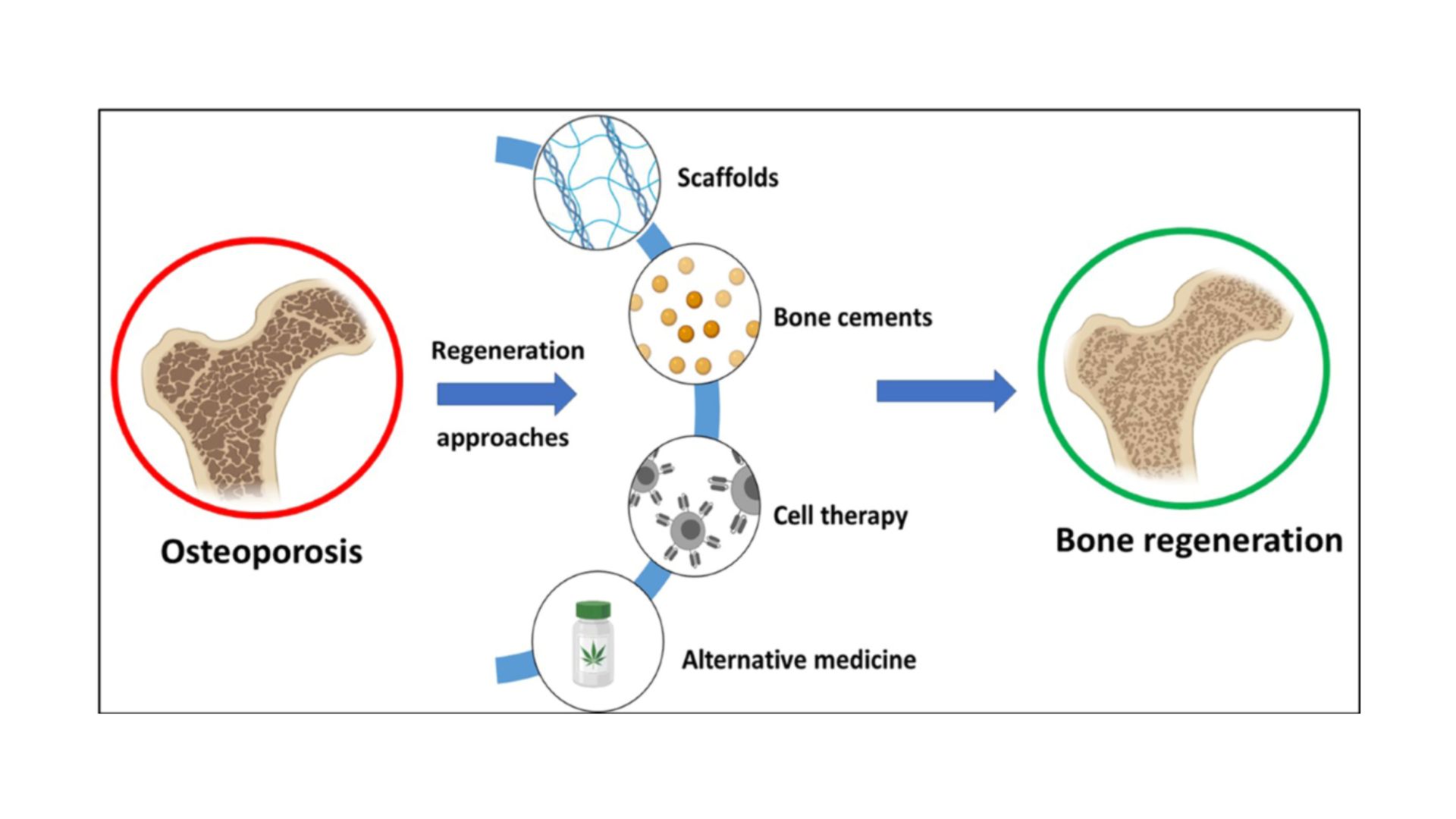 New directions in osteoporosis treatment Focus on bone regeneration science