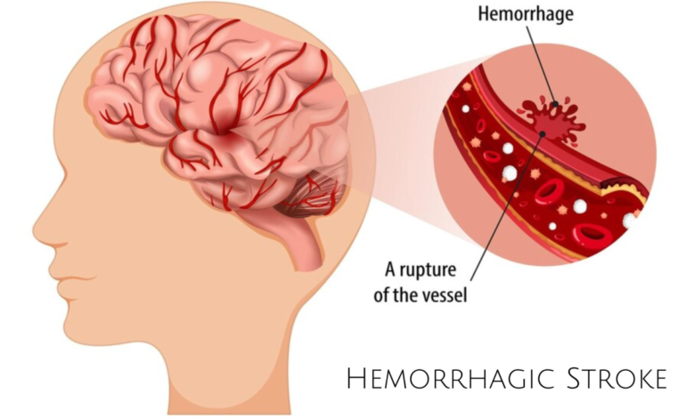 Healthy Heart, Healthy Life : Stroke, blood clots & vascular disease