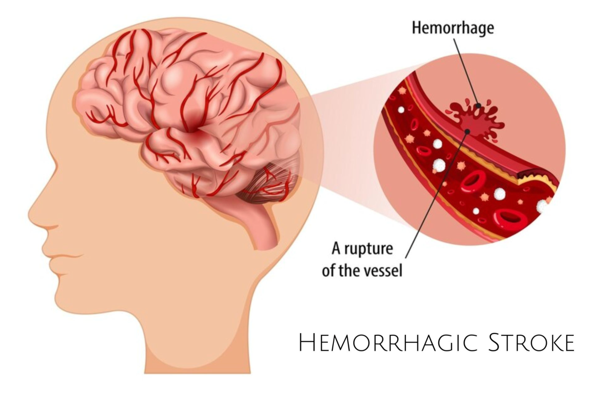 Healthy Heart, Healthy Life : Stroke, blood clots & vascular disease